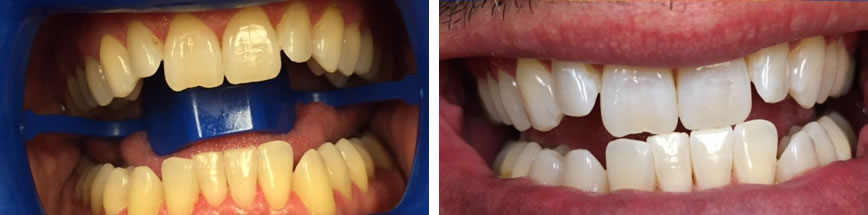 Teeth Whitening #1