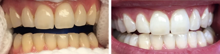 Teeth Whitening #2
