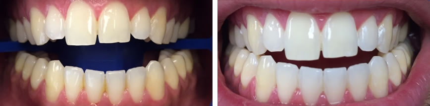 Teeth Whitening #3