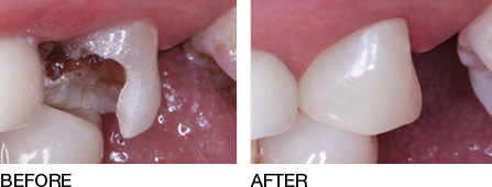 Same-Day Crowns to Restore broken teeth