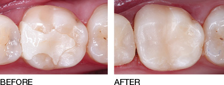 Same-Day Crowns to Replace existing large fillings