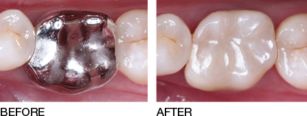 Same-Day Crowns to Remove the metal from your mouth