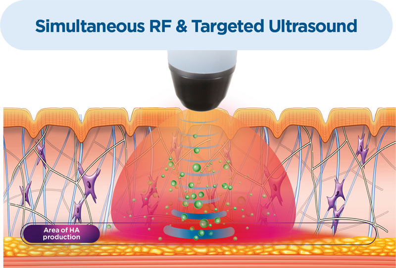 Exion RF Ultrasound