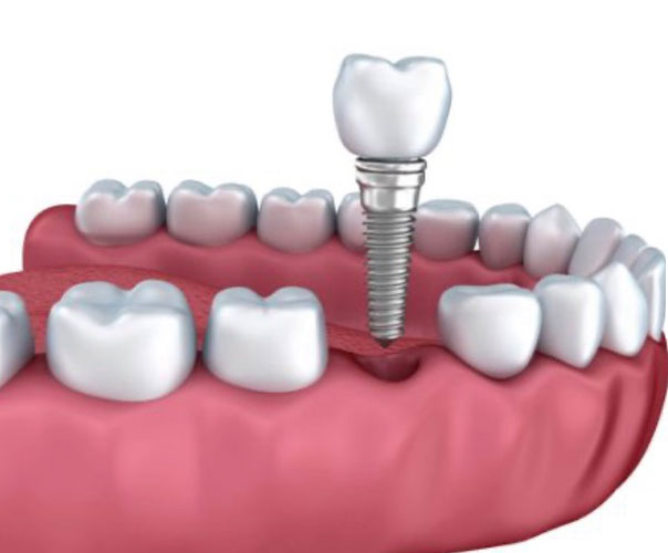 Single Tooth Implants in Allentow, PA