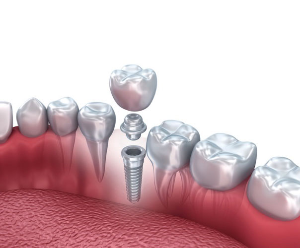 Single Tooth Implants